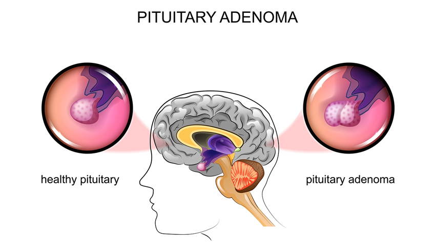 brain-pituitary-adenoma-treatment-in-lucknow