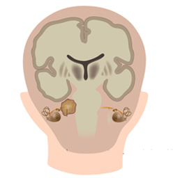 Acoustic Schwannoma