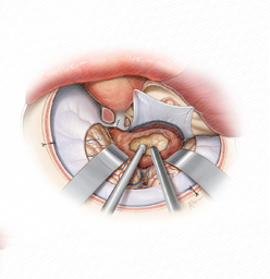 Cavernous Sinus Tumor