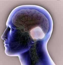 CP Angle Tumor