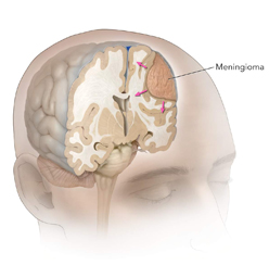 Meningioma