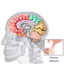 Pituitary Adenoma