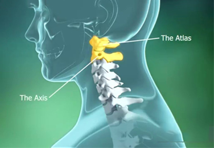Atlanto-Axial Dislocation