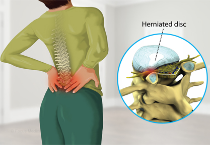 Disc Prolapse