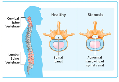 Lumbar Canal Stenosis