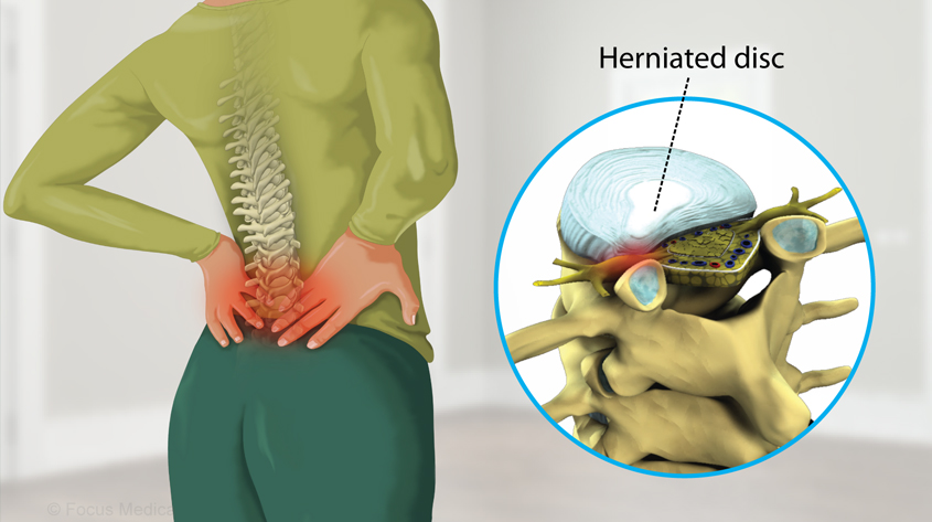 Disc Prolapse